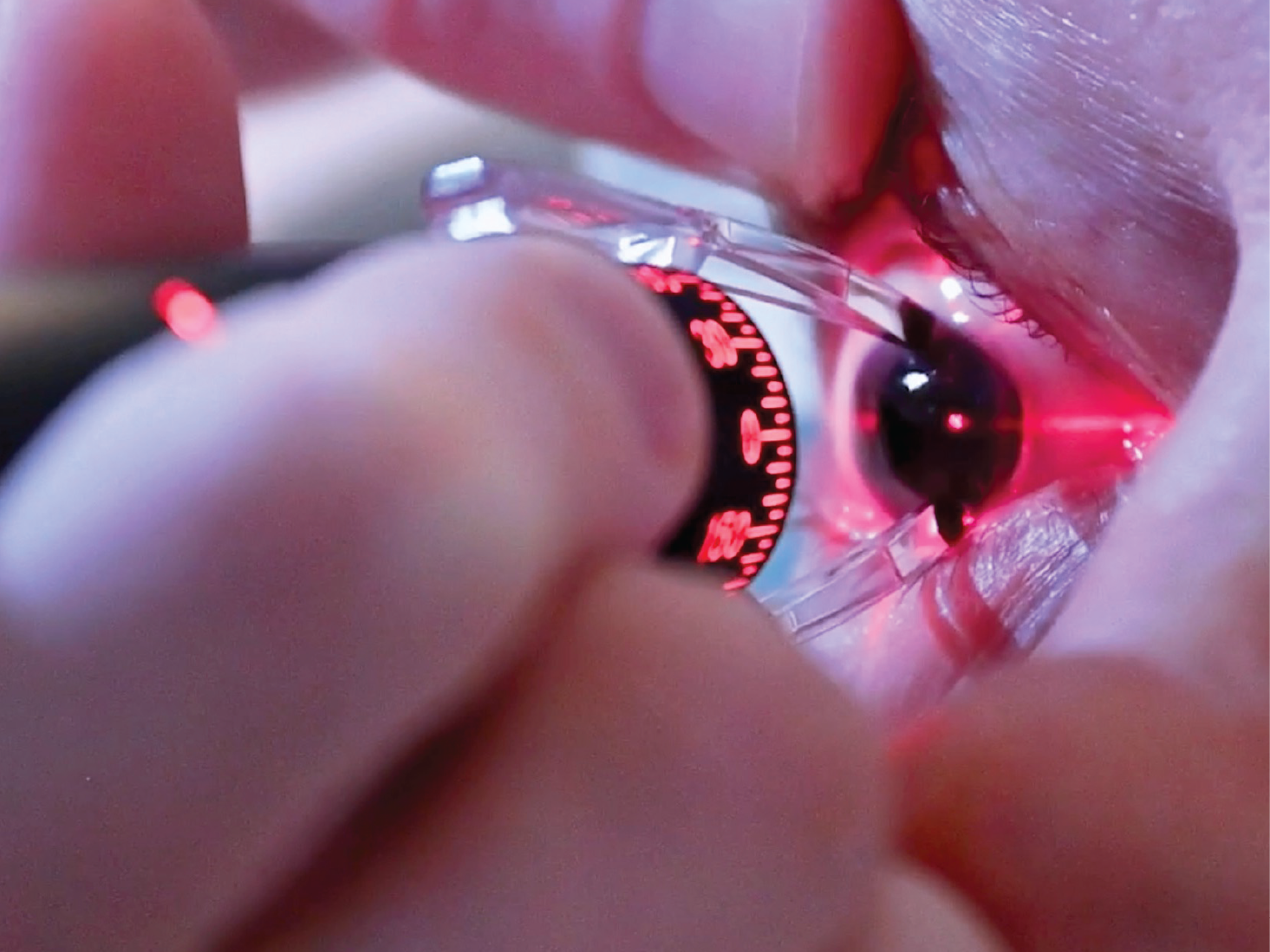 RoboMarker G2 - Surgeon to Procurement Approval Kit